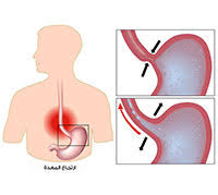الارتجاع المريئي